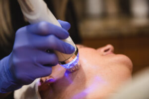 An Erasable Med Spa team member gently stamps microneedles into a patients cheek, which can combat dull skin during skin toning in Tampa.